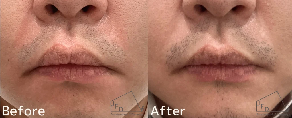 口囲皮膚炎の治療症例を紹介１