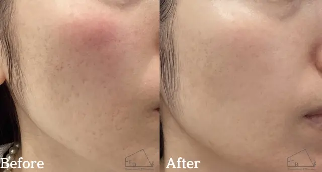 ポテンツァニキビ跡治療症例2