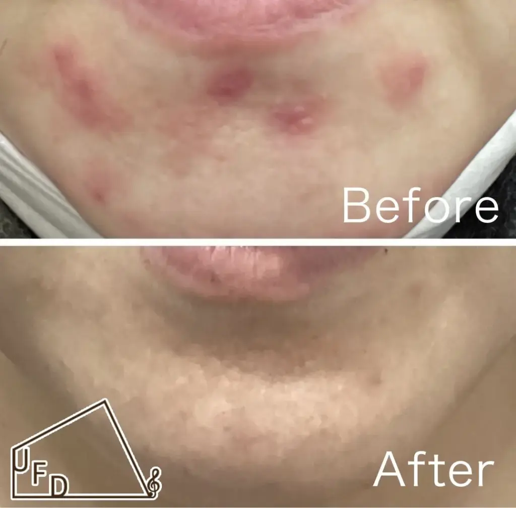 ポテンツァの症例1