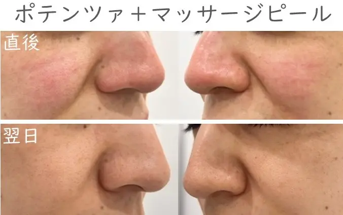 ポテンツァ+マッサージピールのダウンタイム