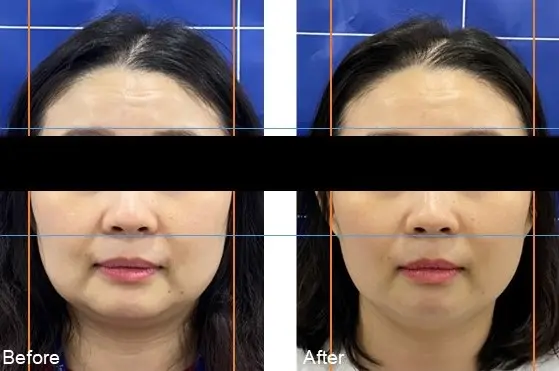 ダイヤモンドチップ症例1