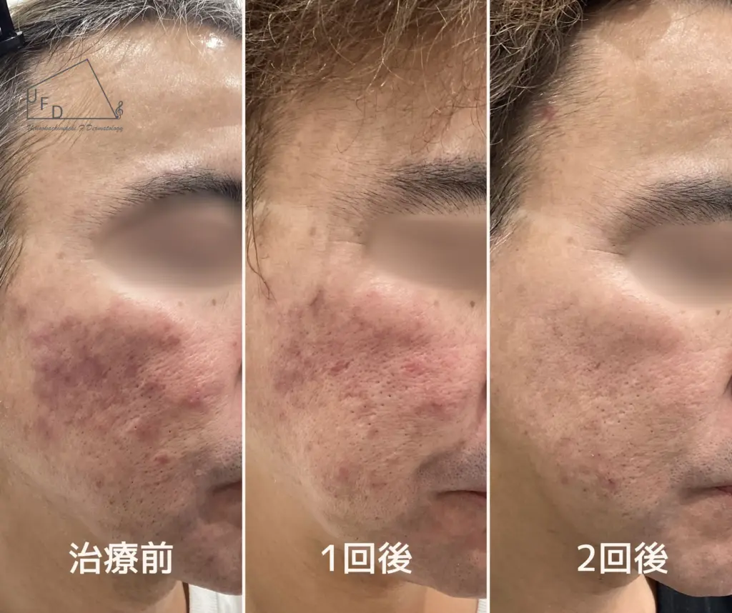 ポテンツァの症例3