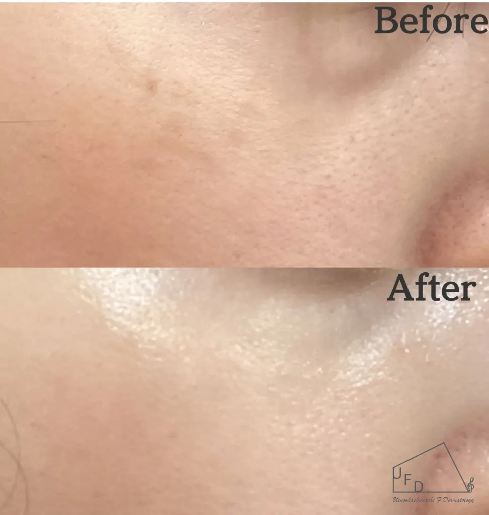 症例1 【30歳代女性】両頬のADM（後天性真皮メラノサイトーシス）