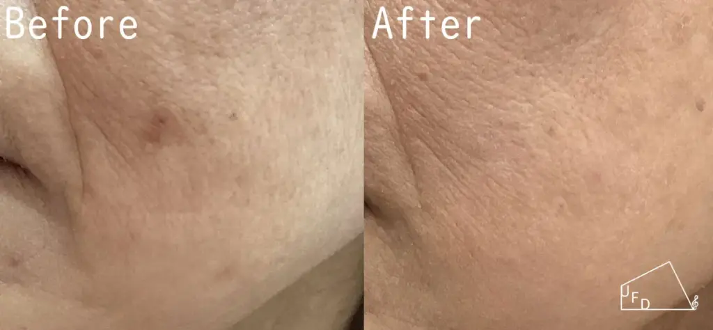 症例4 【50歳代女性】左頬のシミ（日光黒子・老人性色素斑）