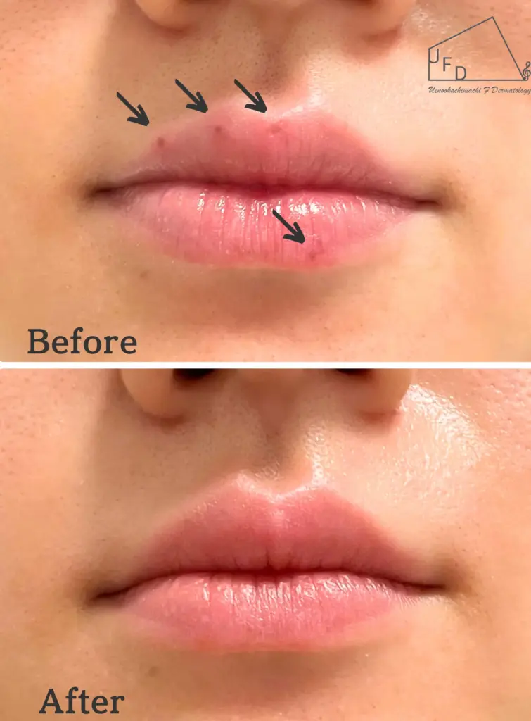 症例6 【20歳代女性】唇のシミ（口唇メラノーシス）