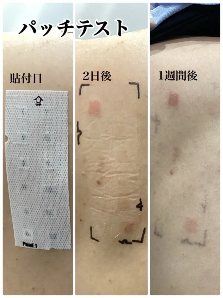 パッチテスト