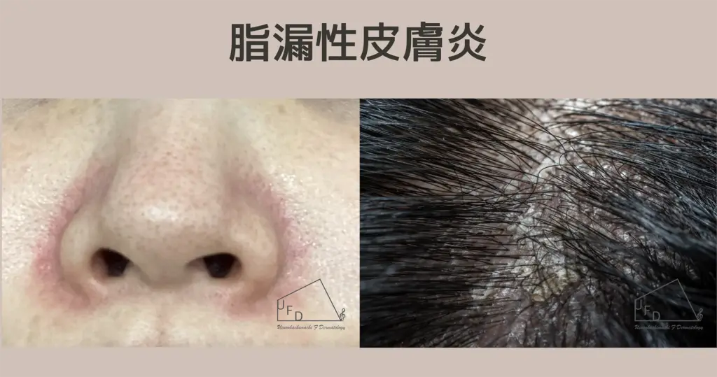 脂漏性皮膚炎治療について詳しく解説