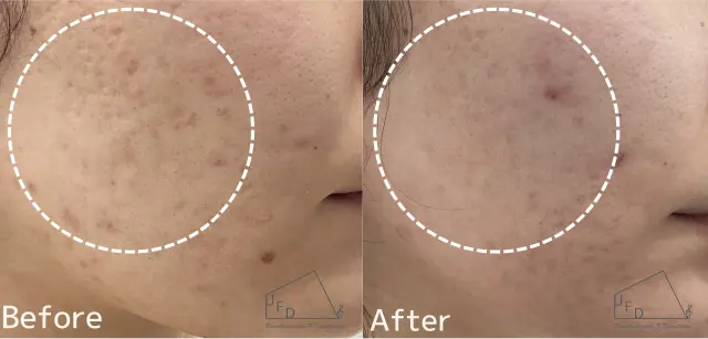 トライフィルプロ症例2