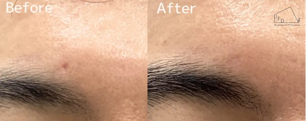 トライフィルプロ症例5