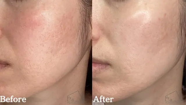 トライフィルプロ症例3