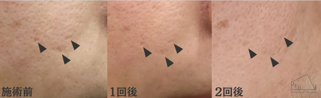 トライフィルプロ症例1