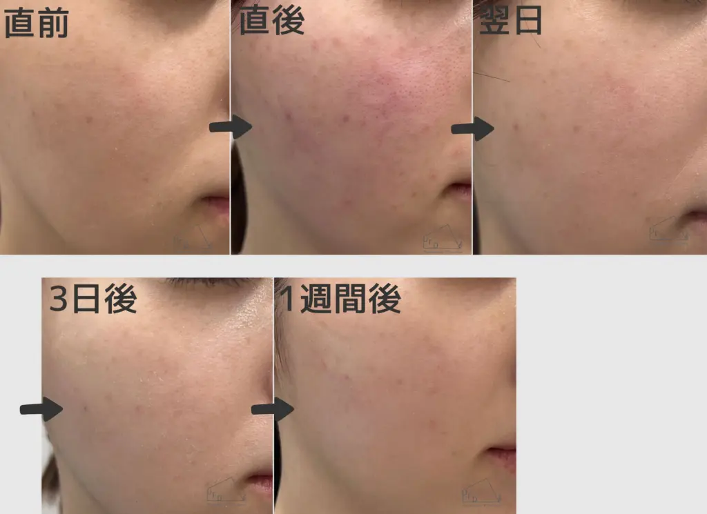 ダウンタイム症例2