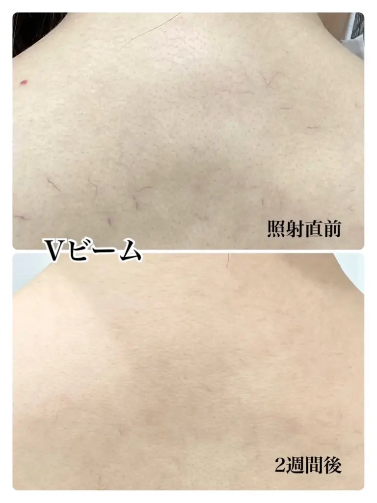 Vビーム症例8