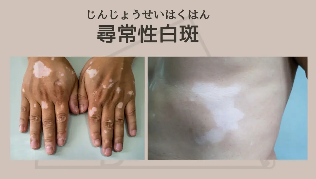 尋常性白斑とは