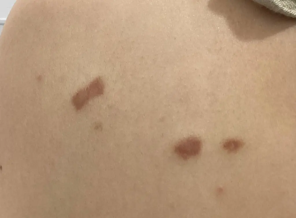 ケロイド・肥厚性瘢痕