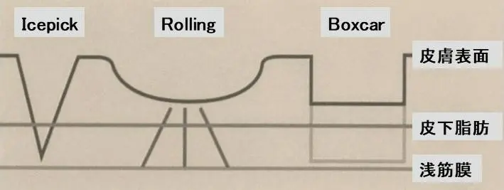 クレーター 瘢痕（萎縮性瘢痕）