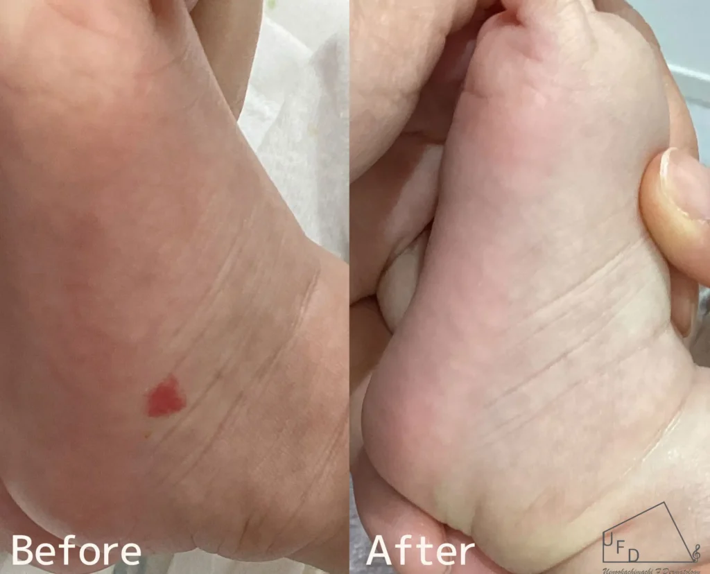 左足の乳児血管腫