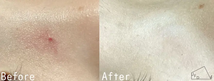 右大腿の乳児血管腫