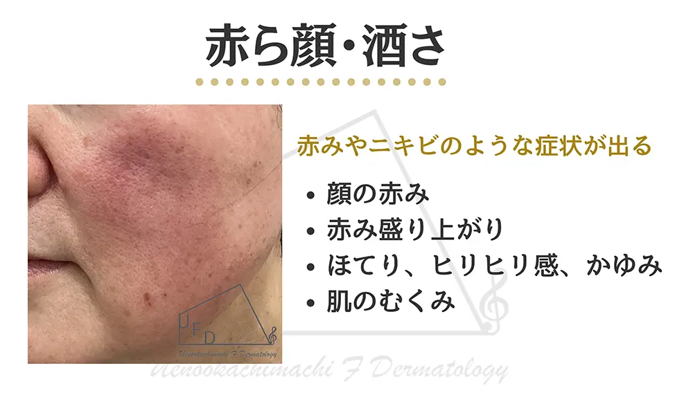 酒さ 赤ら顔の画像