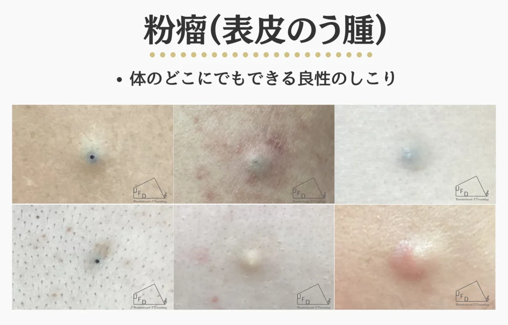 皮膚にできる良性腫瘍の一種 粉瘤について詳しく解説