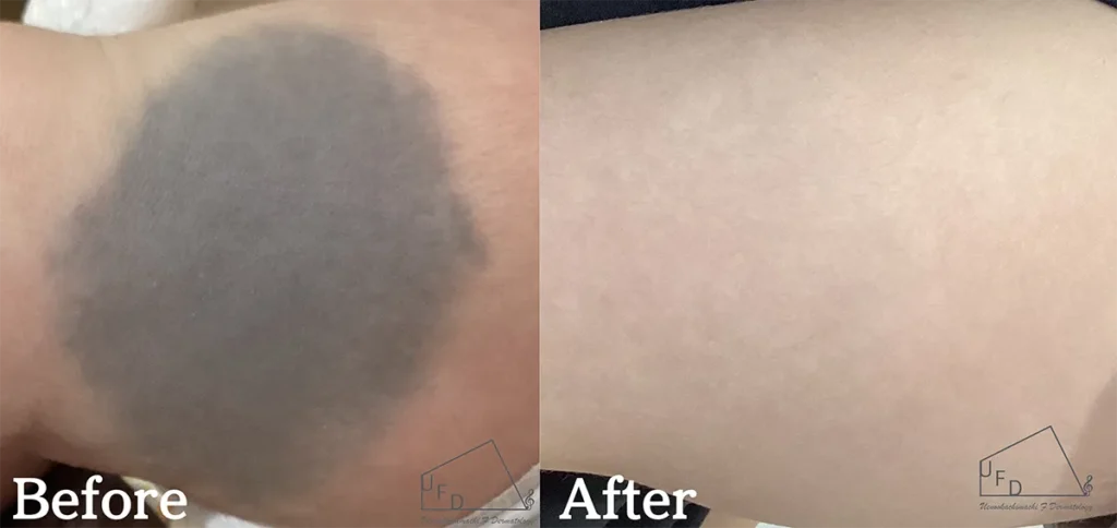 右大腿の異所性蒙古斑