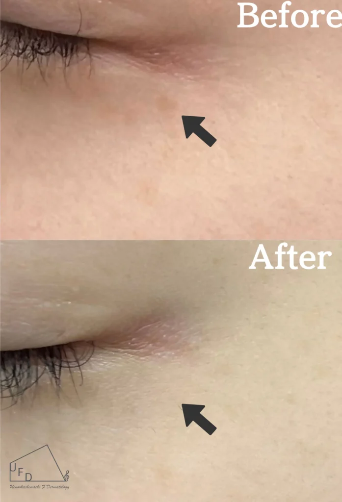 左目の下のシミ