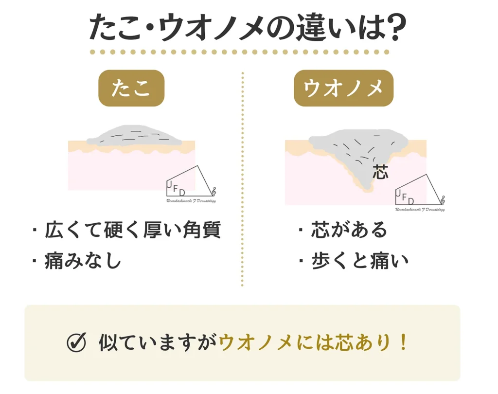 たこ うおのめの患部を断面図にて解説します