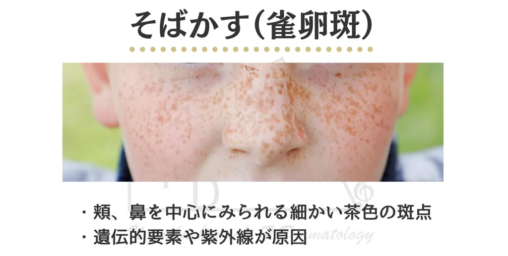 そばかすの患部写真