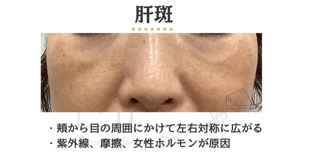 肝斑の患部写真