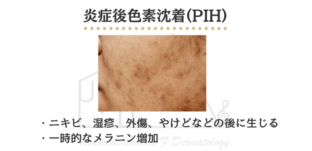 炎症後色素沈着 PIHの患部写真