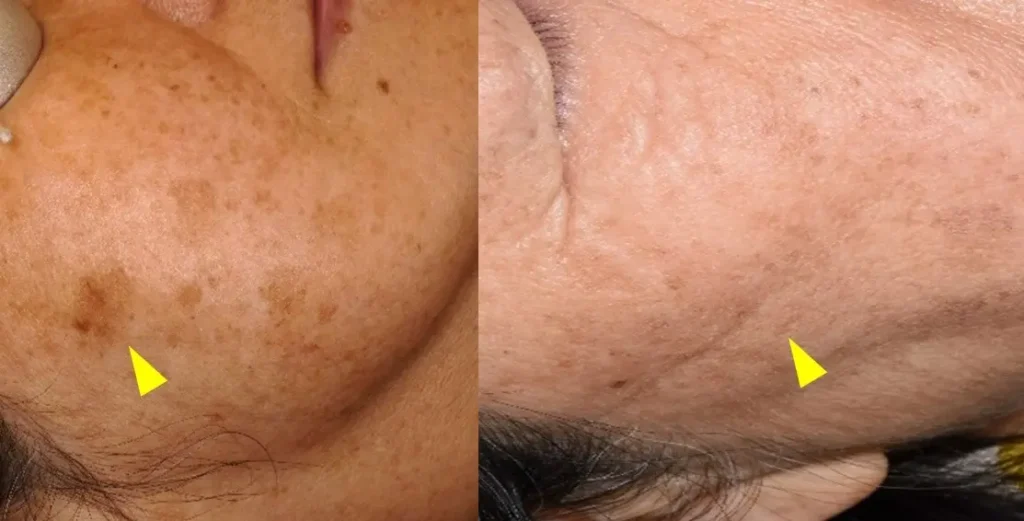 日光黒子 治療前後2