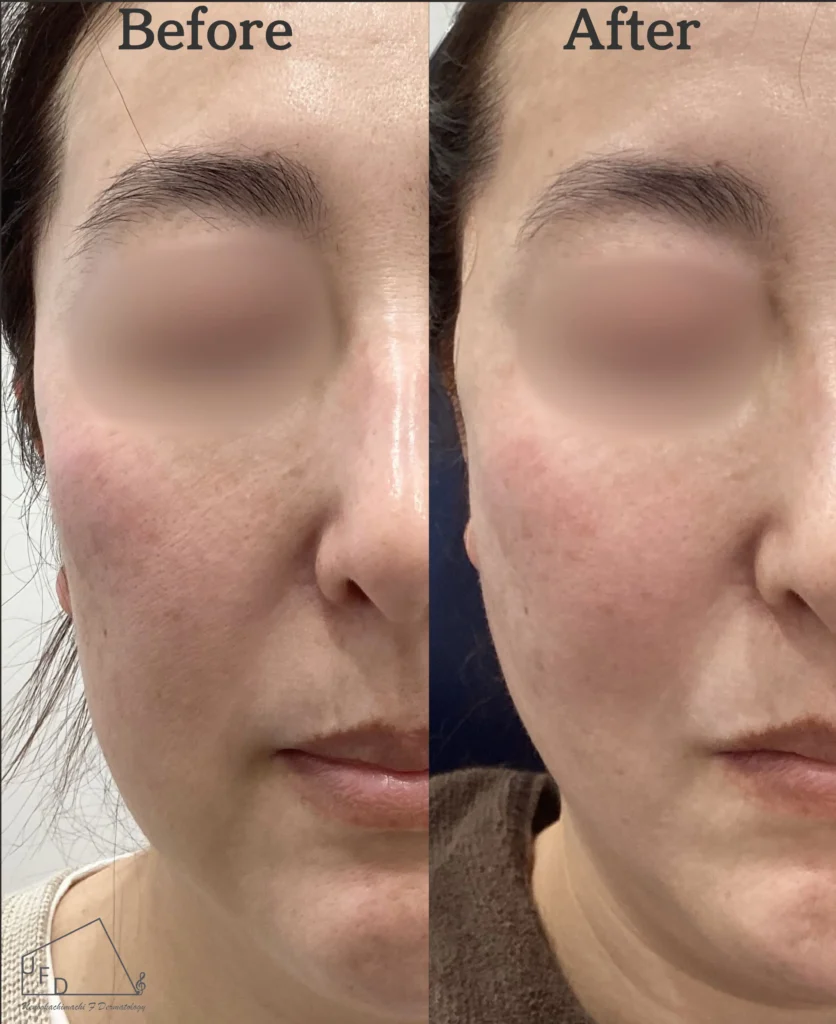 ほうれい線の改善