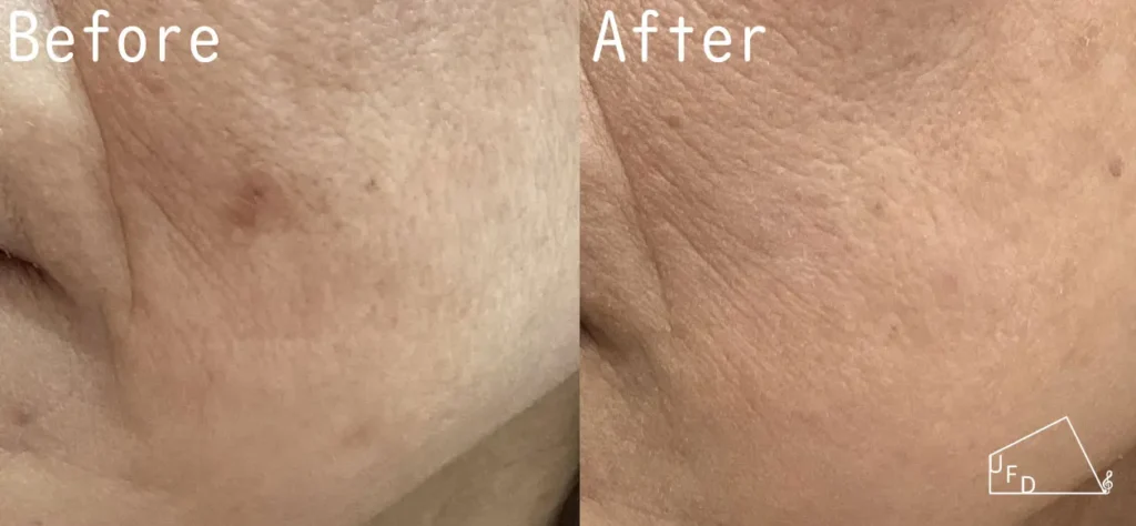 日光黒子 治療前後