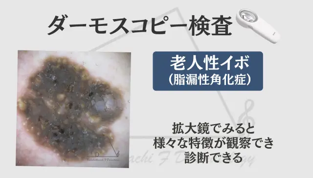 ダーモスコピー検査で見た老人性イボ