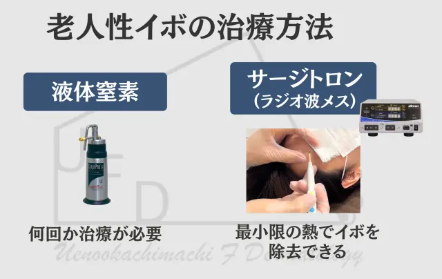 老人性イボ(脂漏性角化症)の主な治療方法