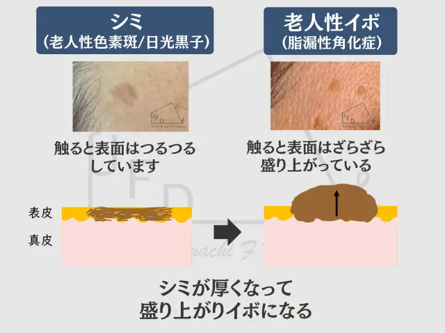 老人性イボ(脂漏性角化症)