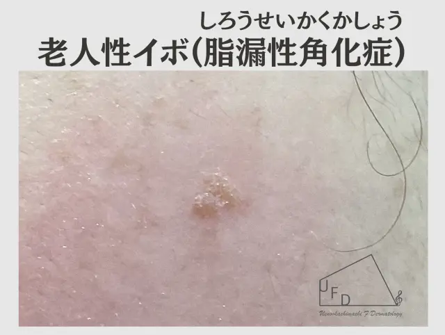 老人性イボ(脂漏性角化症)