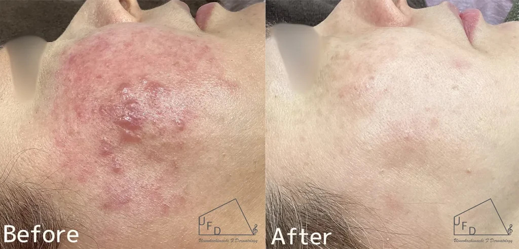 酒さ 赤ら顔の症例写真（治療前後）