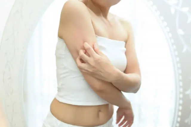 アトピーの画像