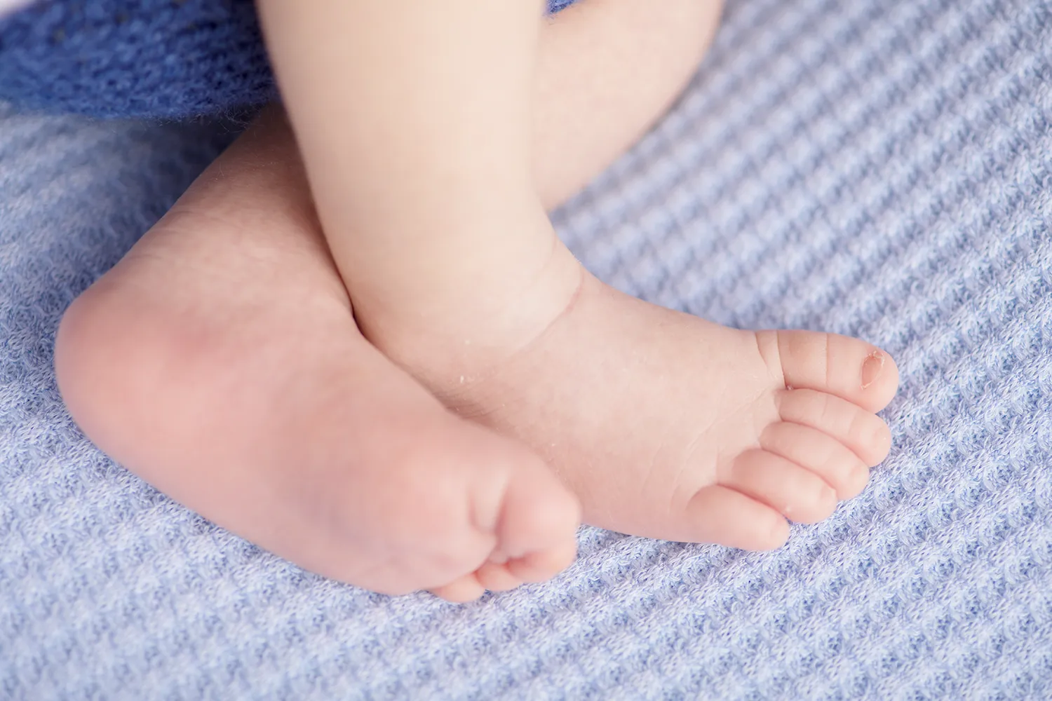 扁平母斑（へんぺいぼはん）とは？原因から治療・保険適用まで徹底解説