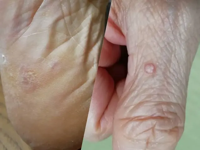 【皮膚科医監修】ウイルス性イボの原因と治療法を徹底解説