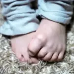 子どもが皮膚をかきむしるのはなぜ？｜かゆみの原因や対処法を知って正しく治療を