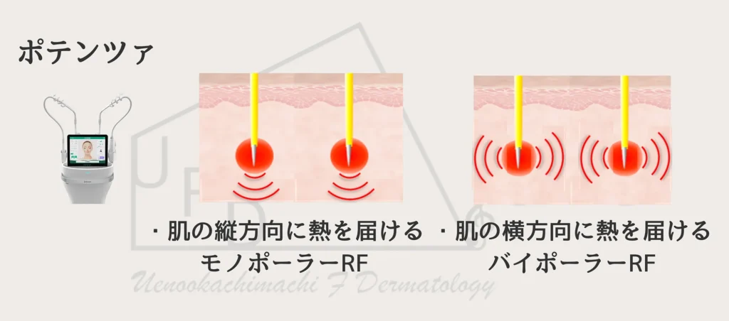 ポテンツァの仕組みについて写真付きで解説します • モノポーラRFとバイポーラRFというチップを使い分けて様々なお悩みにアプローチします