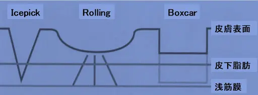 ローリング型のニキビ跡