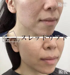 症例1 【30歳代女性】ほうれい線の改善(糸リフト+ヒアルロン酸注入実施)