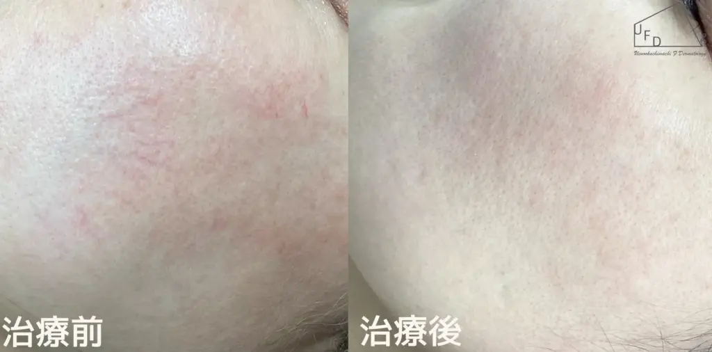 症例1 【40歳代女性】頬の毛細血管拡張