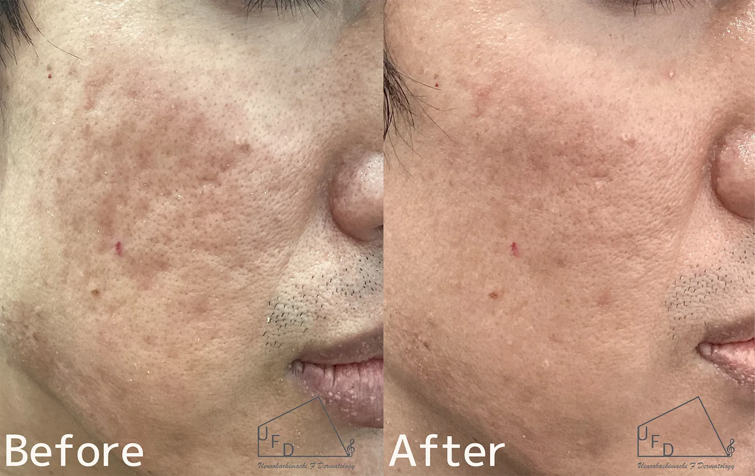 サブシジョンの施術症例について解説 症例1