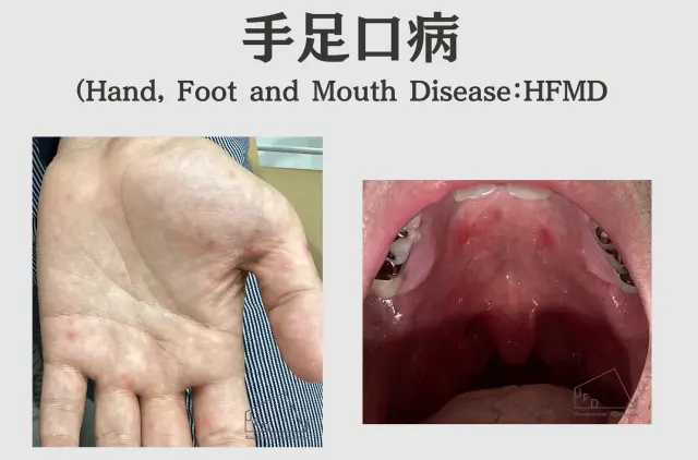 手足口病