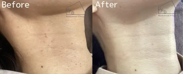 症例 2【30歳代女性】首のイボ