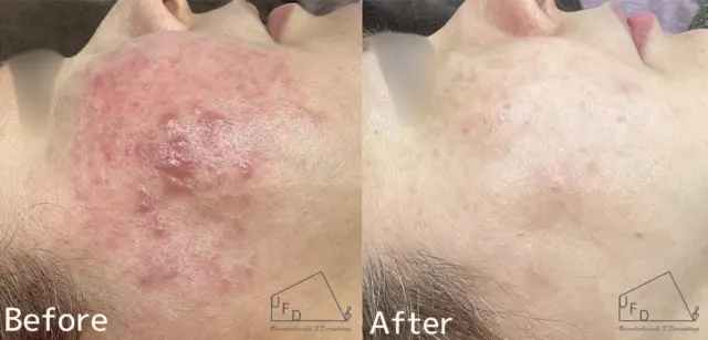 症例4 【40歳代女性】酒さ・赤ら顔